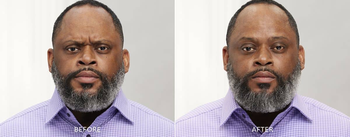 Before and after photos of a man showing frown lines between the brows before and no lines after Botox treatment.