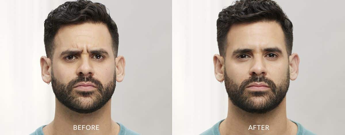 Before and after photos showing a man with frown lines before Botox treatment in Baltimore and no lines after.