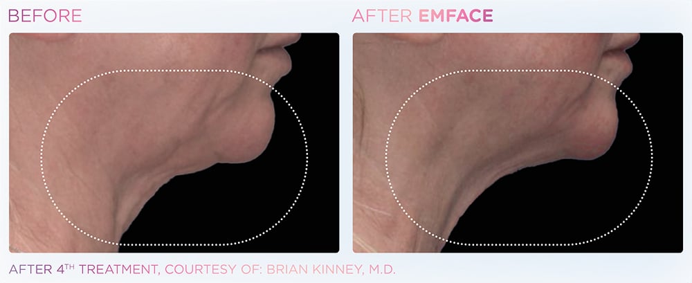 Emface_neck_before_and_after