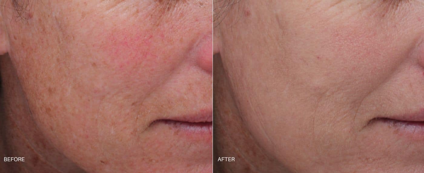 Before and after photos of a woman's cheek showing discoloration before and more even skin tone after Moxi Laser treatment in Baltimore.