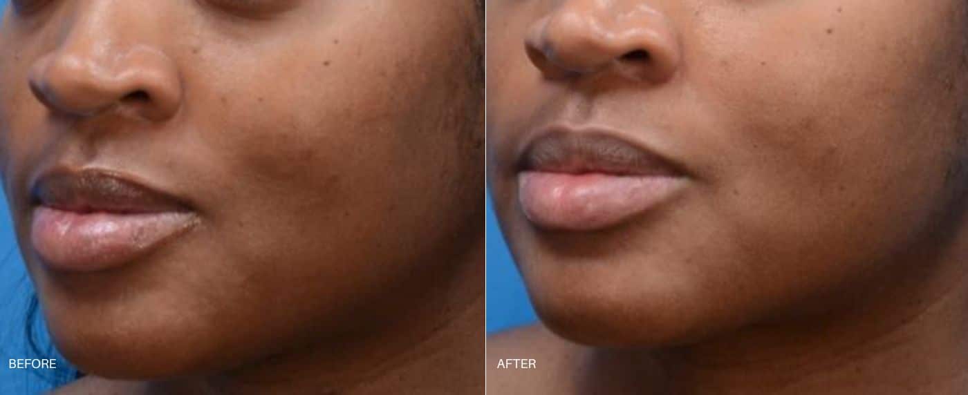 Before and after photo of a woman's face showing discoloration before and smoother, brighter skin after Moxi Laser treatment in Baltimore, MD.