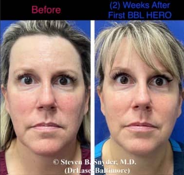 skin rejuvenation before and after photos