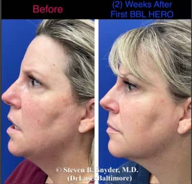 skin rejuvenation before and after photos