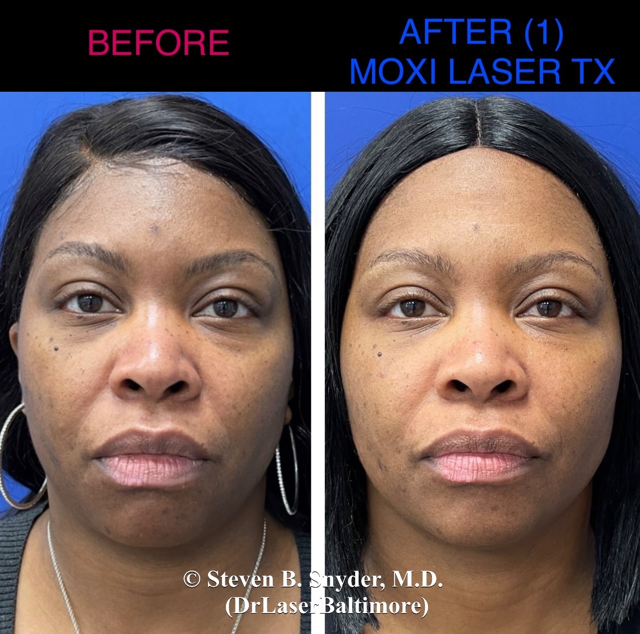 Before and after photos of a woman's face showing uneven skin tone before and brighter, more even skin after Moxi Laser treatment in Baltimore.