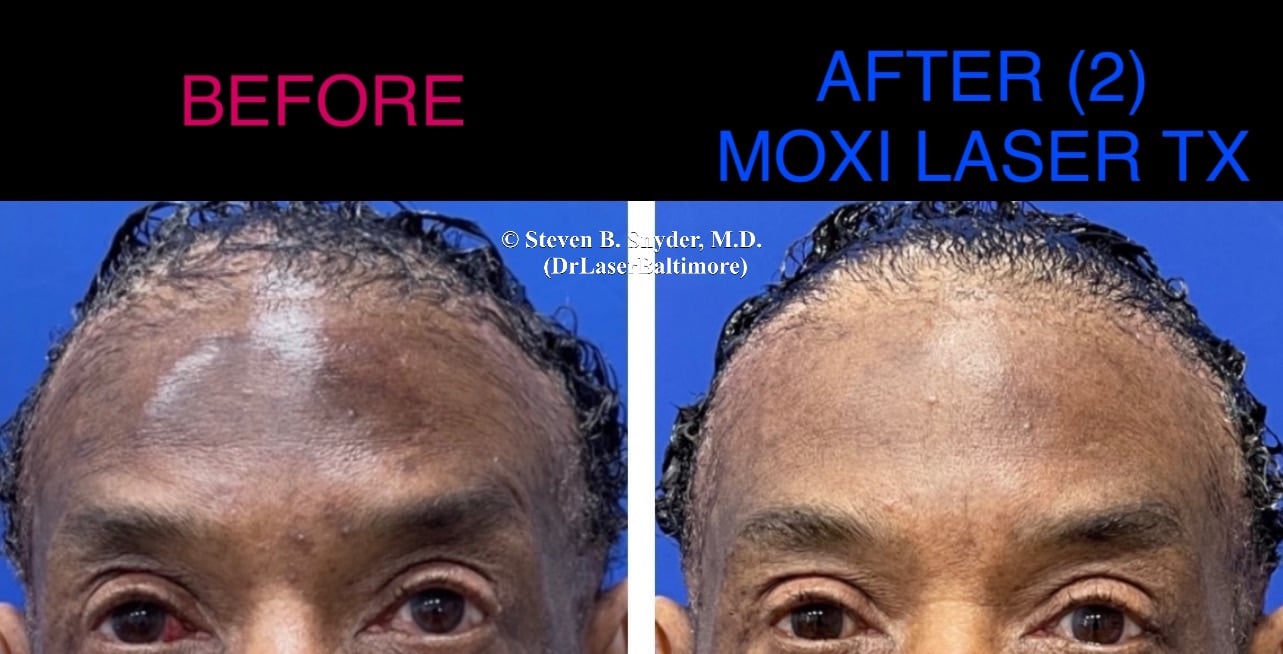 Before and after photos of a man's forehead showing hyperpigmentation before and smoother, clearer skin after Moxi Laser treatment in Maryland.
