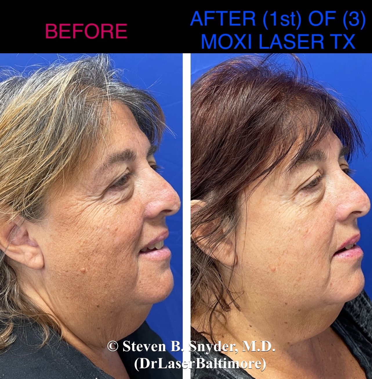 Before and after images showing a woman's face with uneven skin tone and texture before and smoother, brighter skin after Moxi Laser treatment in Baltimore.