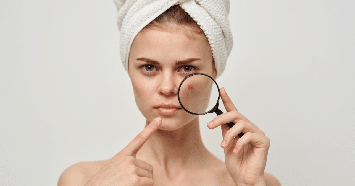 a woman with a magnifying glass examining her acne