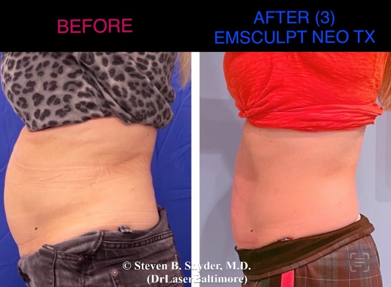 Before and after photos showing a woman's abdomen with more fat before and less fat and more muscle after Emsculpt Neo treatment in Baltimore.