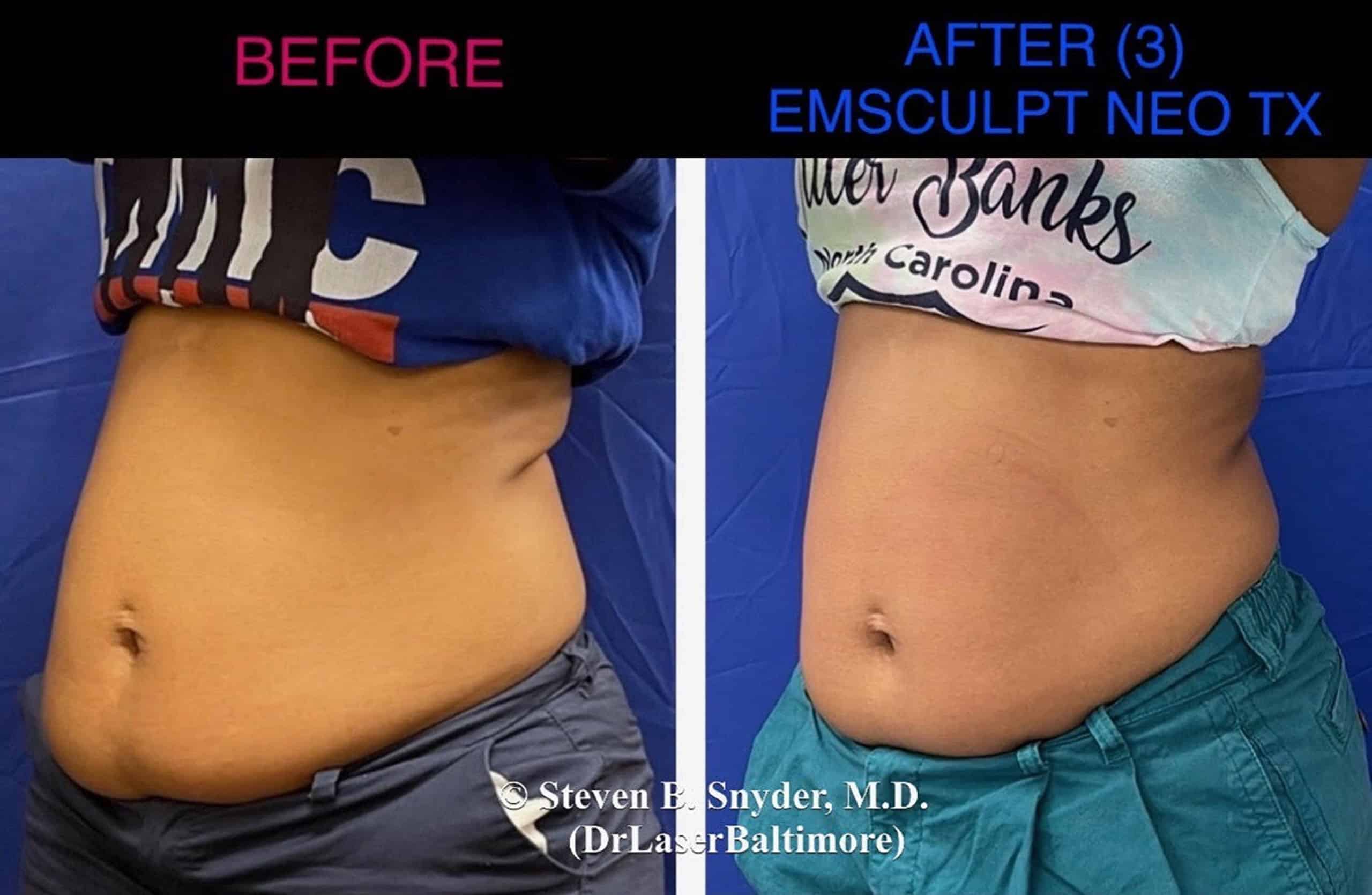 A woman's abdomen before and after the emsculpt procedure showing more fat before and less fat after.