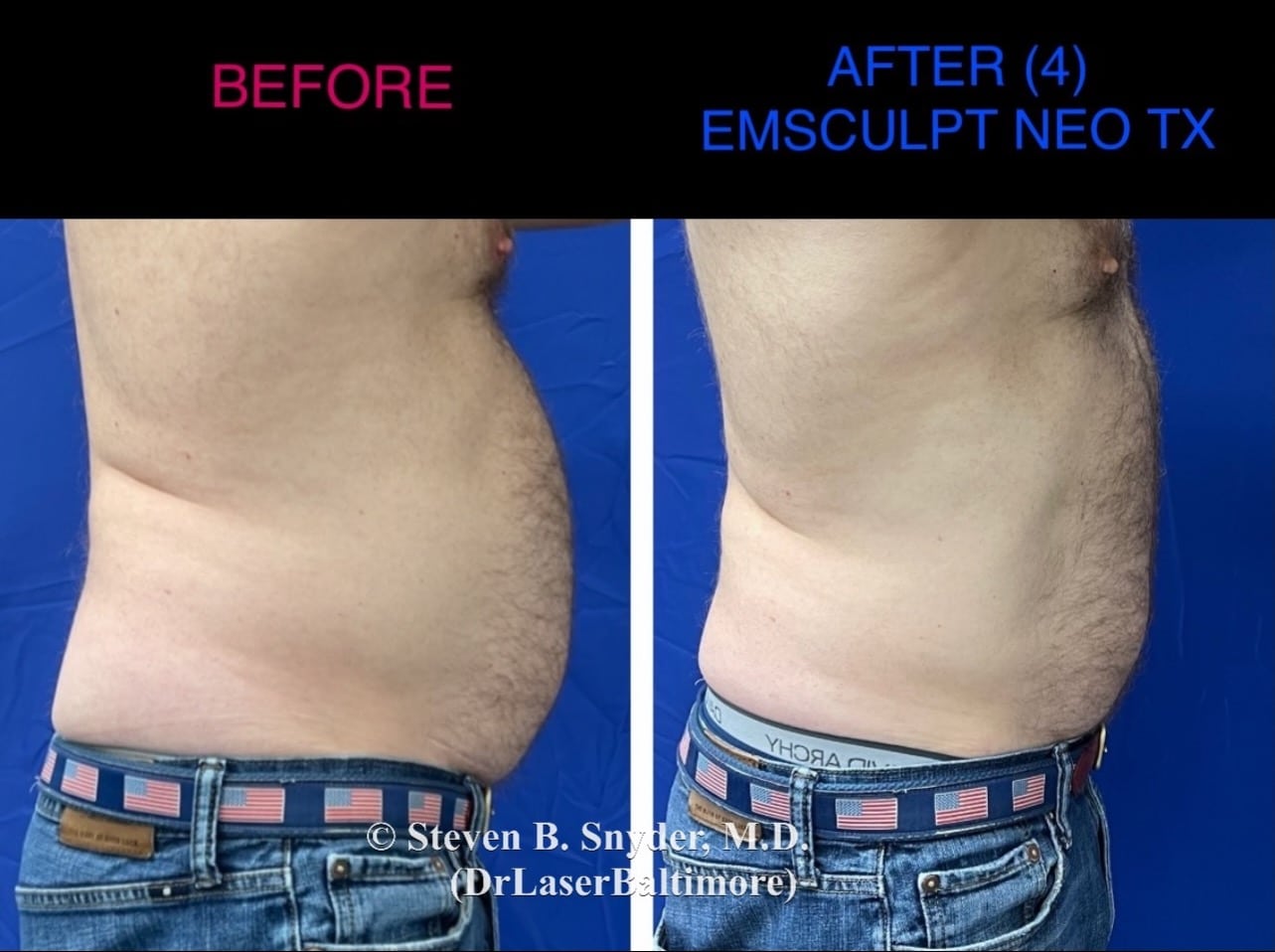 Before and after images of a man's abdomen showing more fat before and less fat and more muscles after Emsculpt Neo treatment in Maryland.