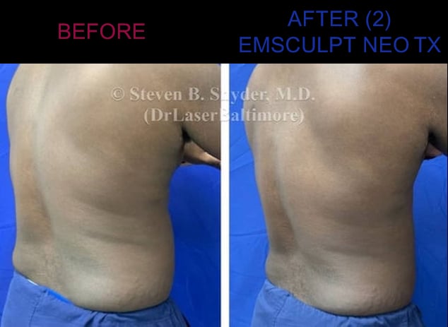 Before and after photos of a man's back showing excess fat before and less fat after Emsculpt Neo treatment in Baltimore.