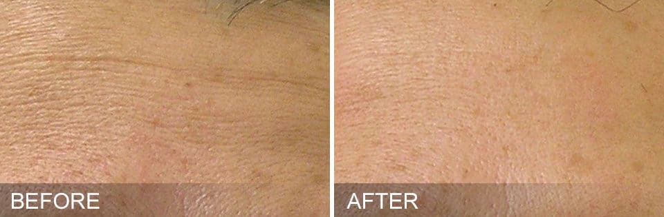 Before and after photo of a woman's forehead showing discoloration and deep lines before and a smoother, more even complexion after Hydrafacial treatment in Baltimore, MD.