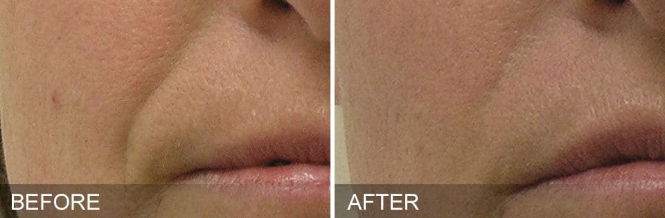 Before and after photos of a woman's lip area showing discoloration and uneven texture before and smoother, more youthful looking skin after Hydrafacial treatment.