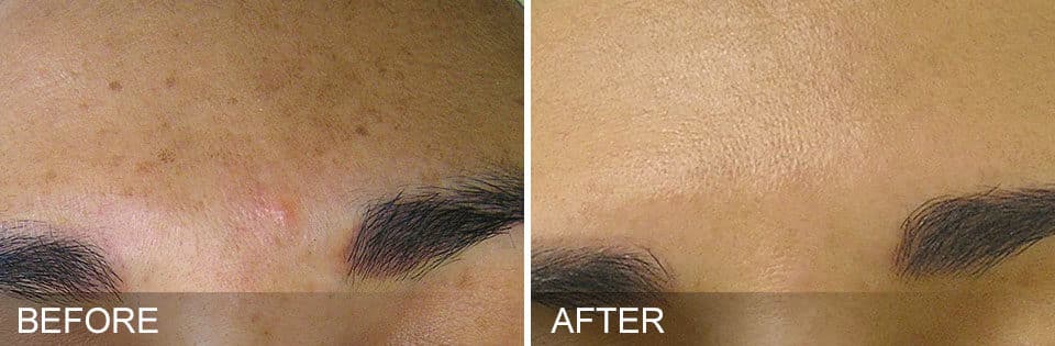 Before and after photos of a woman's forehead showing discoloration before and smoother, even skin after Hydrafacial treatment in Maryland.