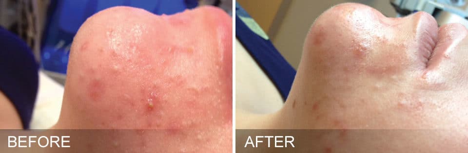Before and after photos of woman's chin with redness and acne before and less inflamed skin after Hydrafacial treatment in Baltimore.