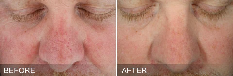 Before and after photos of a man's face with redness and inflammation before and more even skin tone after Hydrafacial treatment in Maryland.