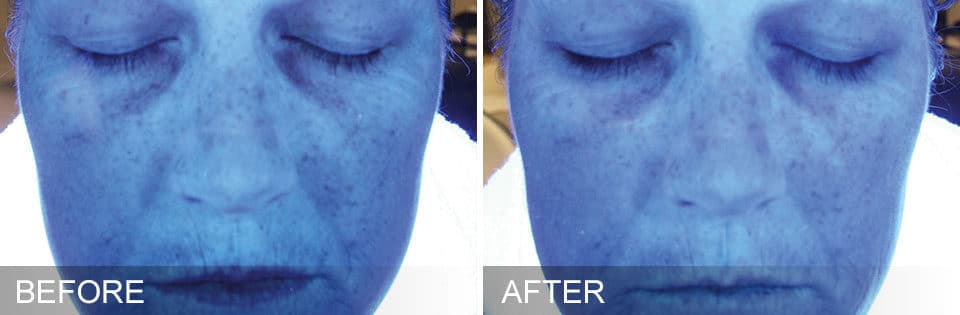 Before and after photos of a woman's face showing sun damage before and less sun damage after Hydrafacial treatment.