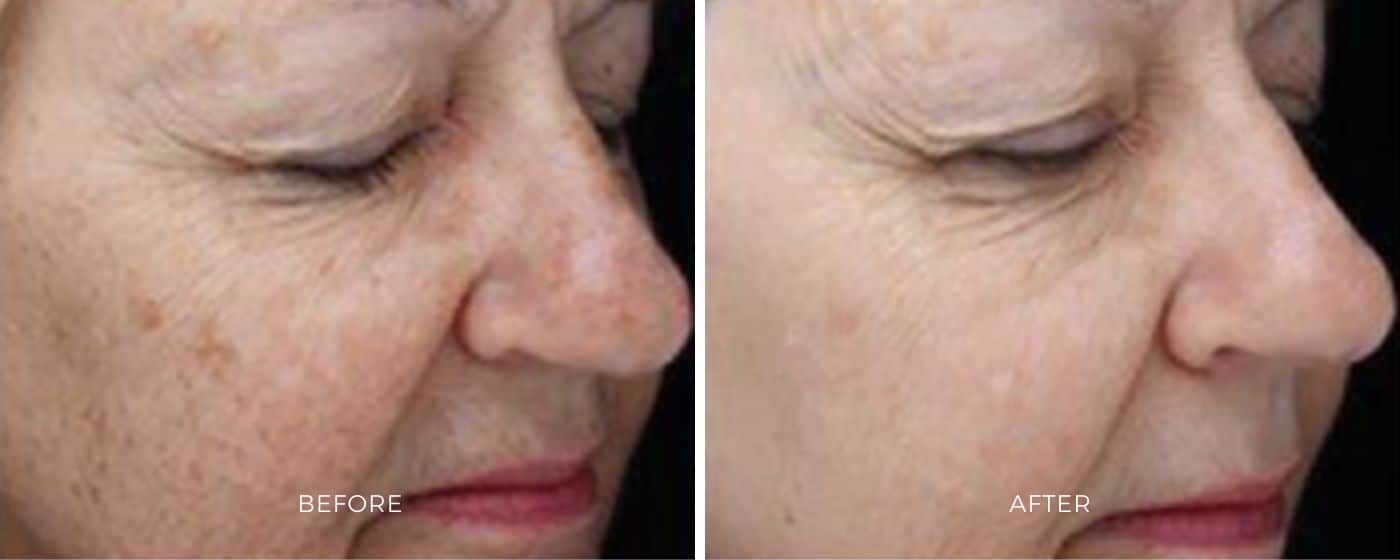 Before and after photos of BBL Hero treatment resulting in clearer and brighter skin.