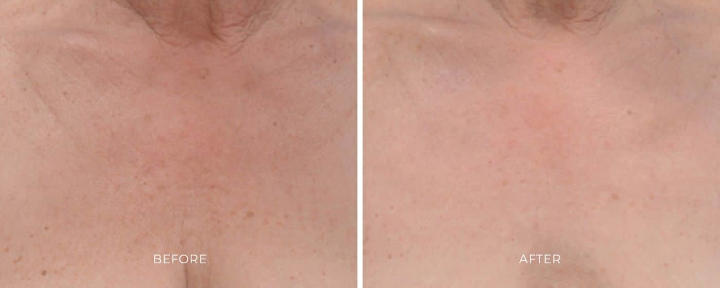 Before and after photos of the BBL Hero treatment resulting in clearer and brighter skin.