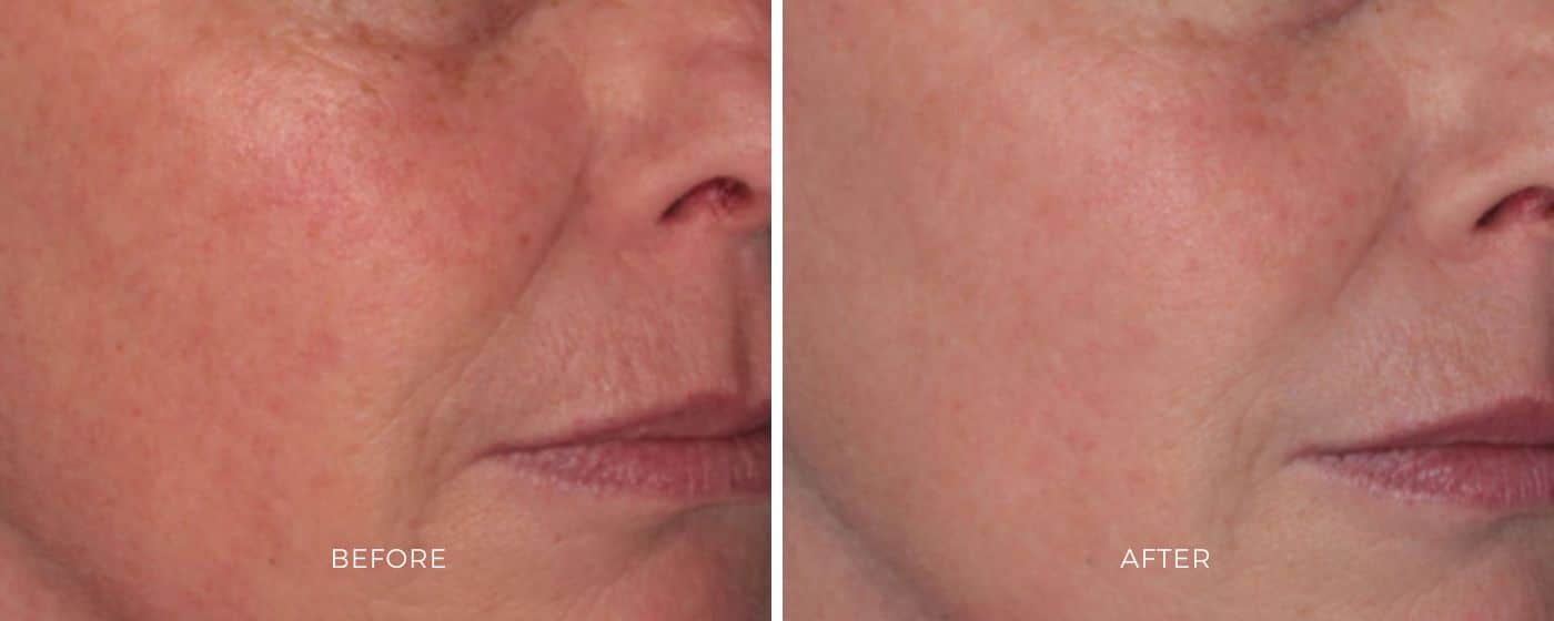 Before and after photos of a woman's face resulting to a brighter and clearer skin from ClearSilk treatment.