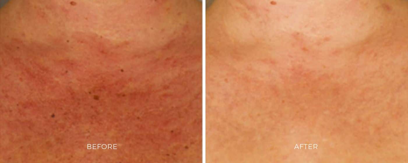 Before and after photos of a closeup shot of the skin showing a clearer and brighter result.