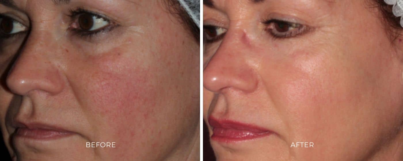 Before and after photos of ClearSilk resulting in brighter and clearer skin.