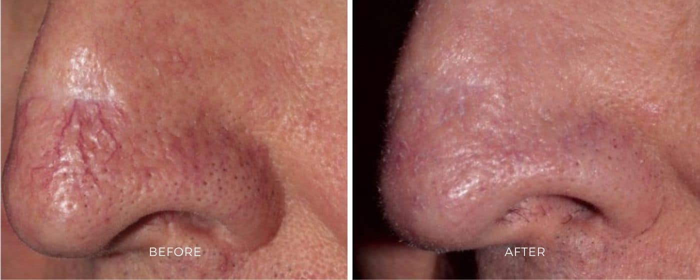 Before and after photos of a nose showing a less noticeable veins from ClearV treatment.