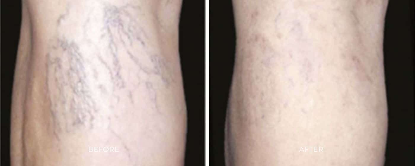 Before and after photos of a leg showing less noticeable veins from the ClearV treatment