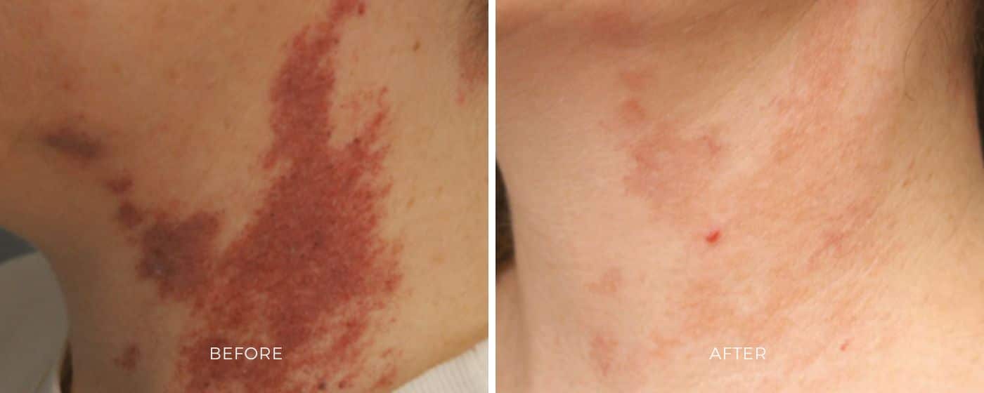 Before and after photos showing a clearer skin appearance from the ClearV treatment