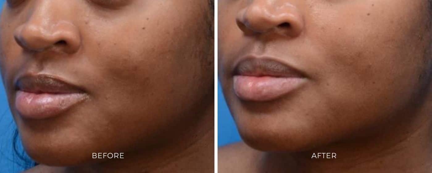 Before and after photos of Moxi treatment showing a clearer and younger skin.