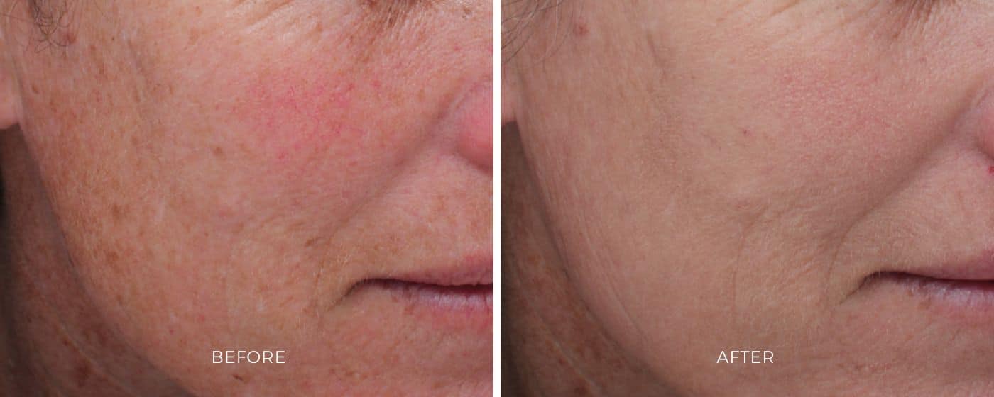 Before and after photos from the Moxi treatment