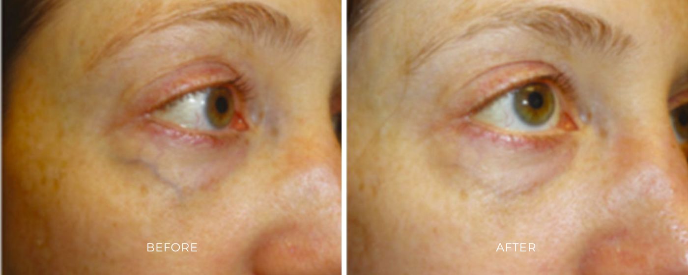 ClearV before and after photos showing an eliminated visible veins in the eye area.