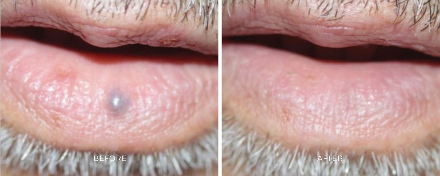 ClearV before and after photos showing an eliminated dark spot on the lip of a man.