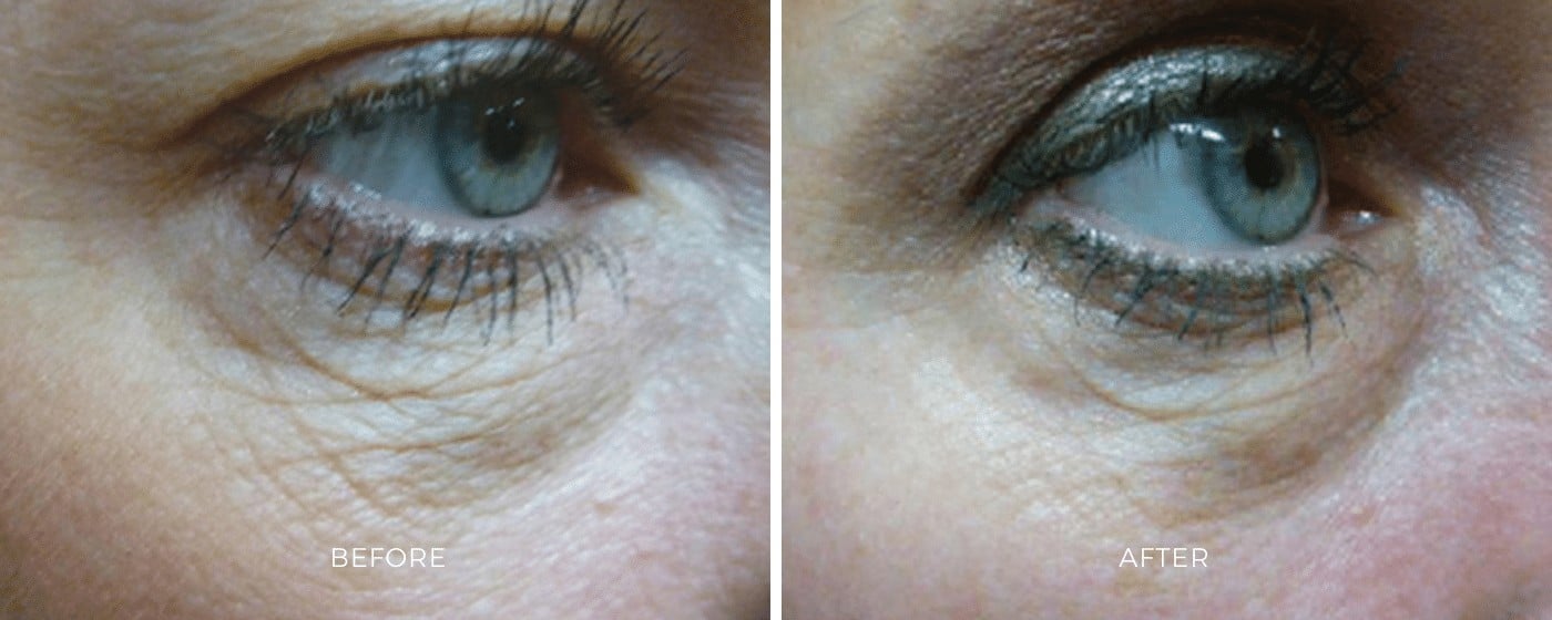 Before and after photos of SkinTyte treatment showing a tighter skin around the eye area.