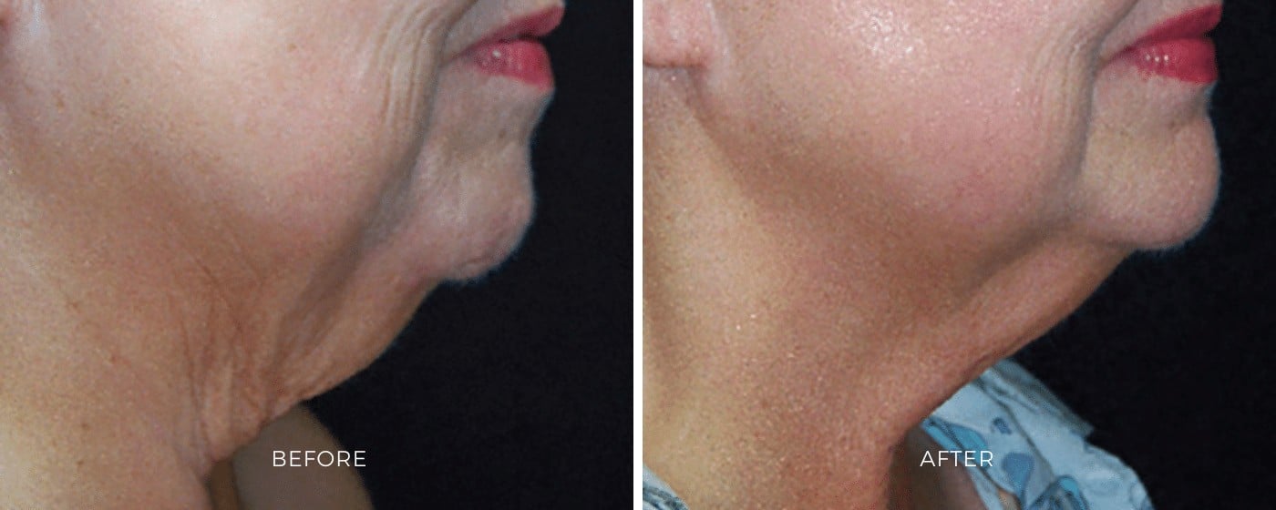 Before and after photos of a SkinTyte treatment showing a tighter muscle that connects the chin and neck.