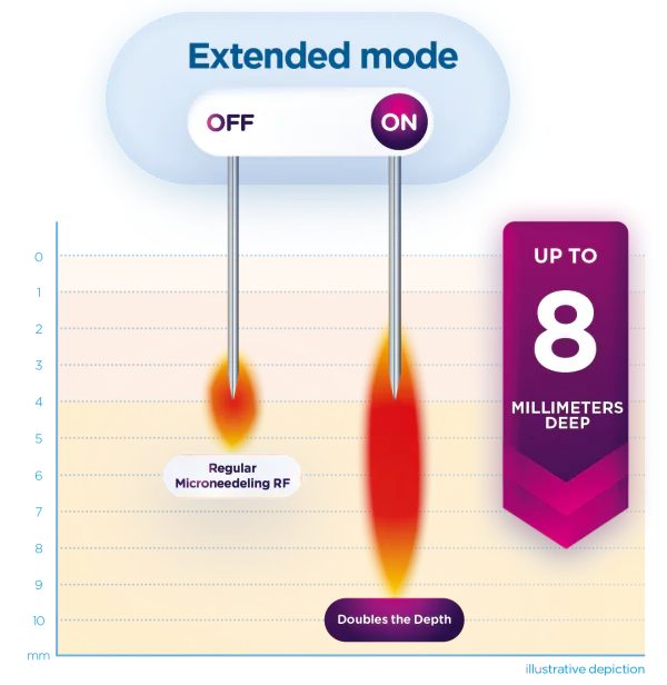 This technology generates thermal stress, which increases blood circulation and stimulates fibroblasts within the dermis. As a result, patients see noticeable improvements in skin texture without the discomfort of other deep tissue treatments. Little to no downtime is involved with such a gentle yet effective solution.